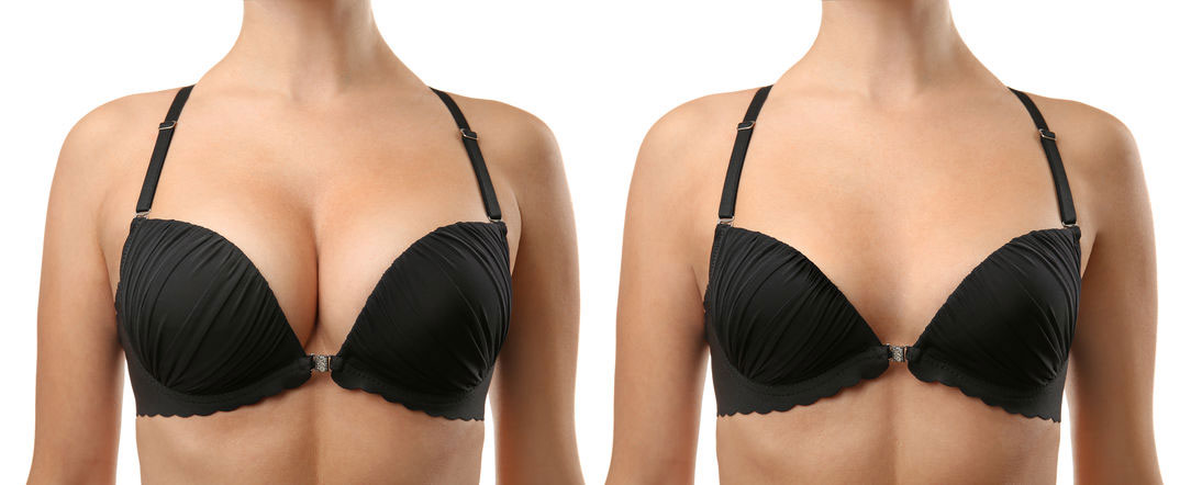 Breast Reduction Surgery Kent